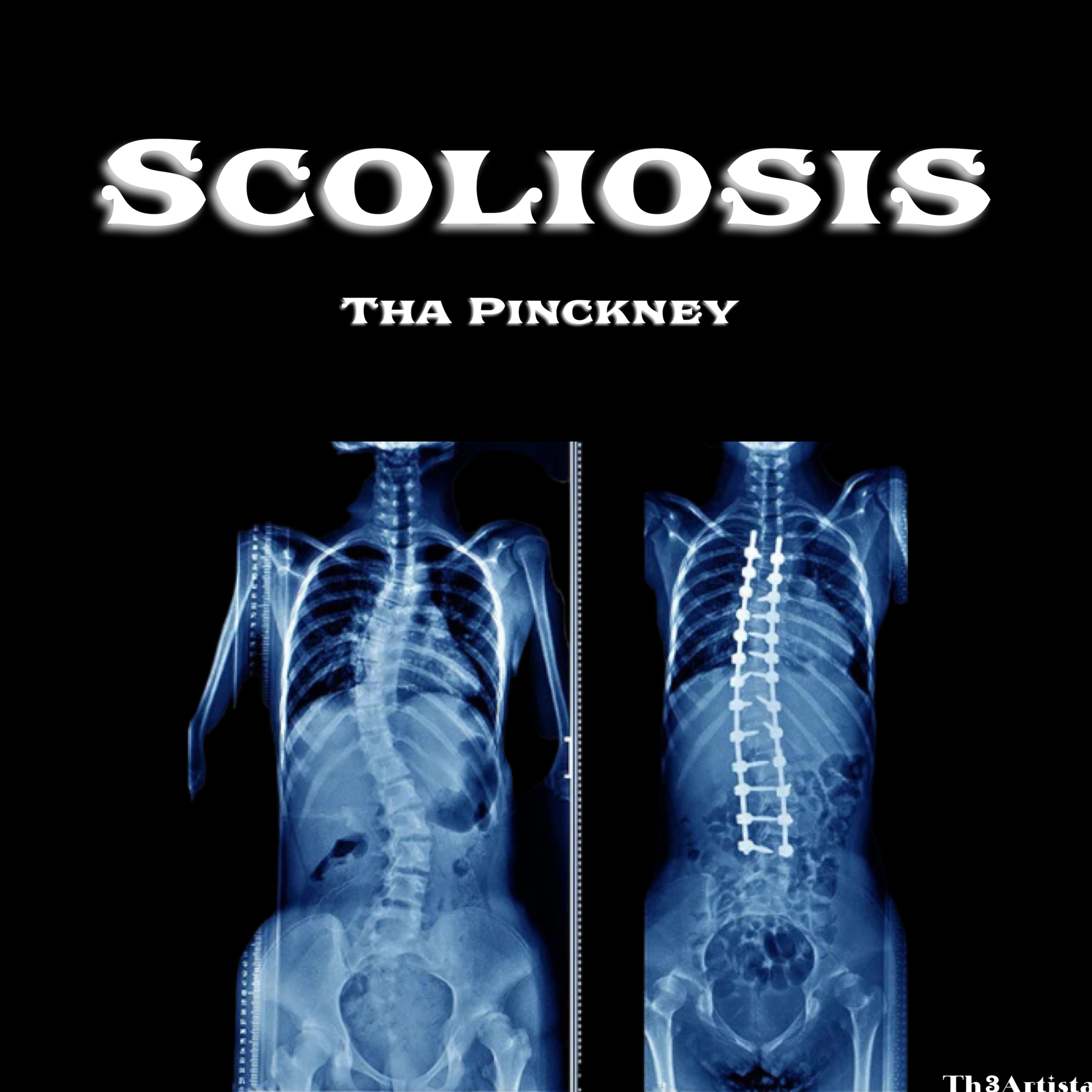 SCOLIOSIS artwork